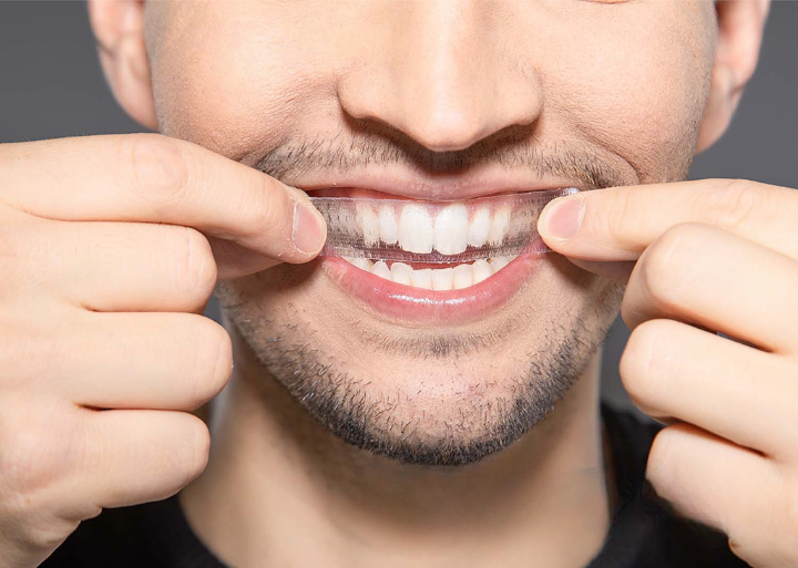 Are Whitening Strips Without Chlorine Dioxide China Effective?